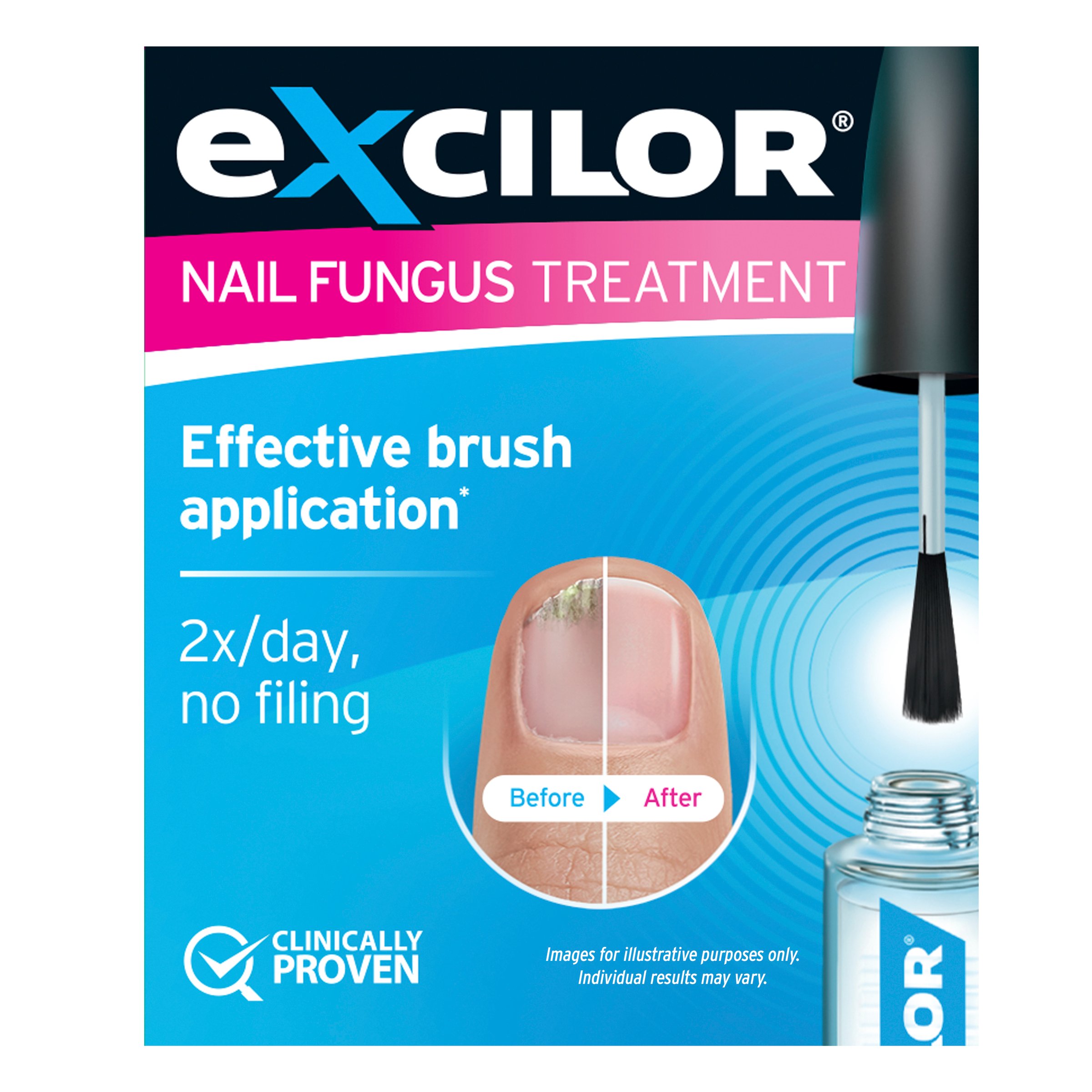 Excilor Nail Fungus Treatment Solution 3.3ml - Image 1