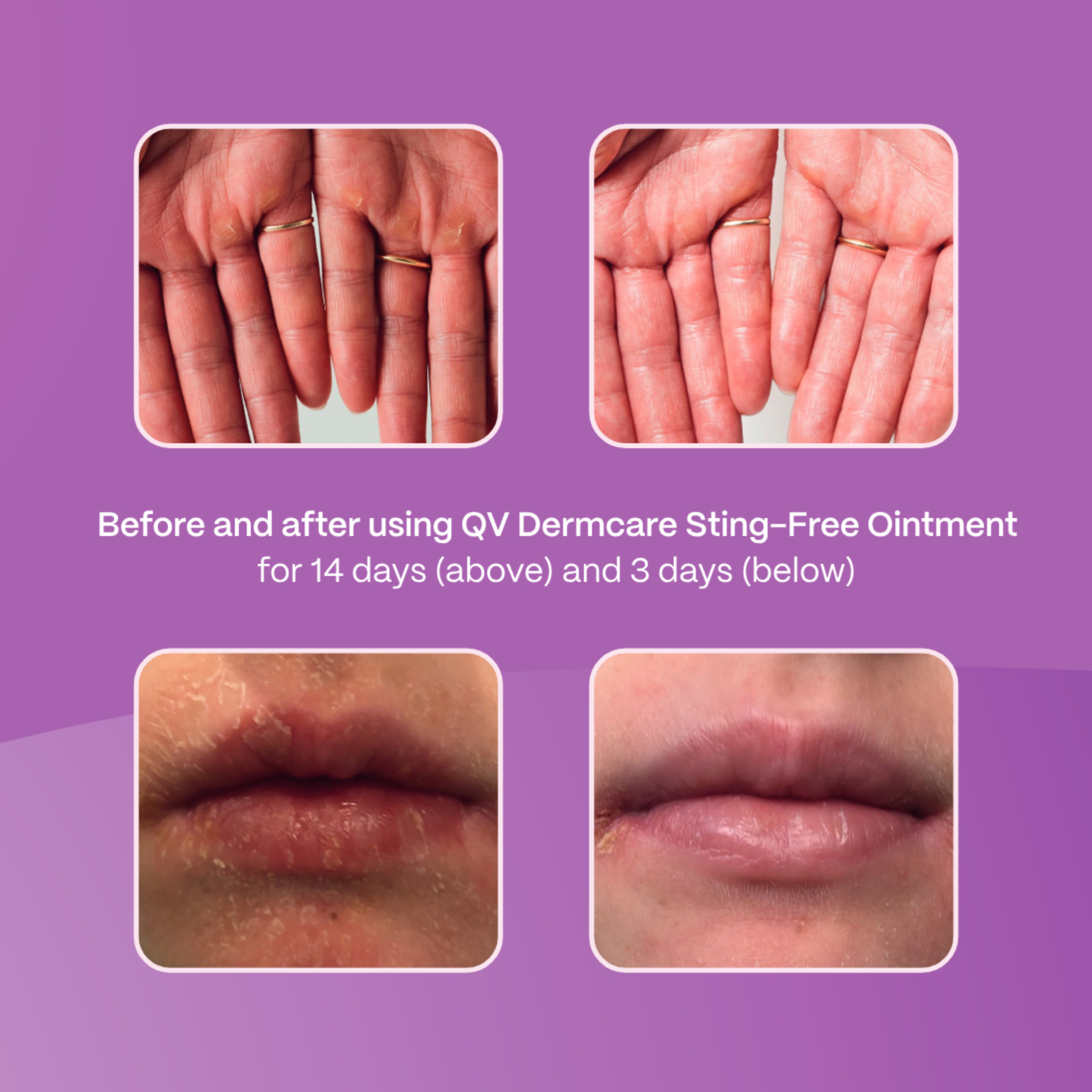 Ego QV Dermcare Sting-Free Ointment 100g - Image 3
